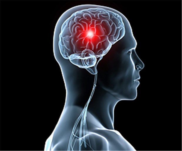Hyperthyreose: Schlaganfall kann früh auftreten Die Hyperthyreose bei jungen Erwachsenen erhöht das Risiko eines Schlaganfalls.
