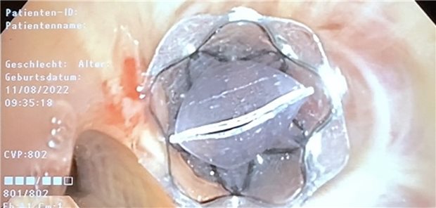 Die Implantation von Ein-Weg-Ventilen führt zu einer lobären Atelektase und Reduktion der Hyperinflation.