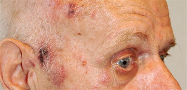 Komplikationen werden immer häufiger Die Inzidenz von Herpes zoster wird zunehmen, zeigen Studiendaten, vor allem ältere Menschen sind betroffen.
