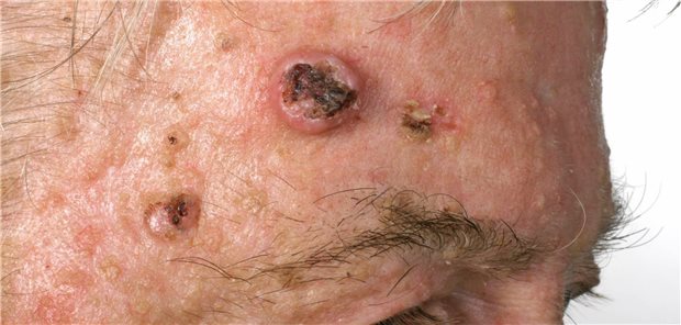 Die Inzidenz von kutanen Plattenepithelkarzinomen hat sich innerhalb von knapp 30 Jahren bei Männern verdreifacht, bei Frauen verfünffacht.