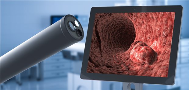 Die Koloskopie ermöglicht Diagnostik
und – mit der Entfernung eventueller Polypen – Therapie in einer Sitzung
(Symbolbild).