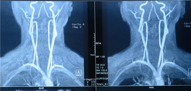 Aufnahmen einer Magnetresonanzangiographie ohne Kontrastmittel von den Halsgefäße eines Patienten.
