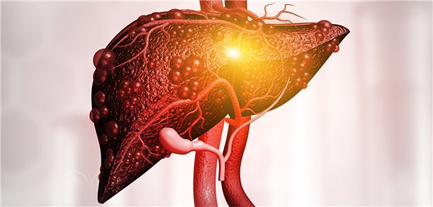 Die Leber im Modell: Jeder zweite Patient mit Typ-2-Diabetes hat eine nichtalkoholische Fettlebererkrankung.