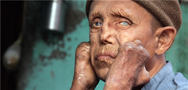 Die Lepra-Erkrankung geht oft mit Behinderungen einher.