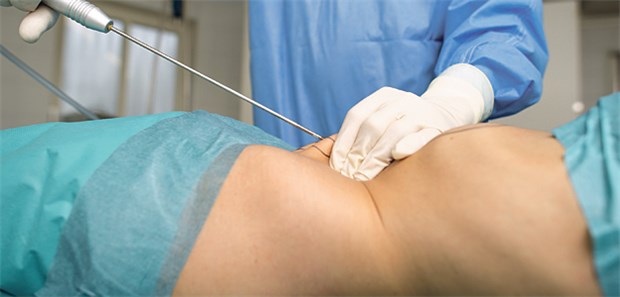 Schönheits-Op steht weiter hoch im Kurs Die Liposuktion war 2014 bei Frauen weltweit der am zweithäufigsten nachgefragte ästhetisch-chirurgische Eingriff.