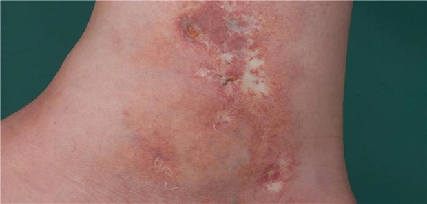 Atrophie blanche in der Malleolarregion bei Livedovaskulopathie.