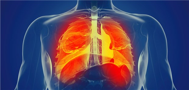 Die Lungen eines Mannes: Die chronisch obstruktive Lungenerkrankung (COPD) zählt zu den weltweit häufigsten Krankheiten.