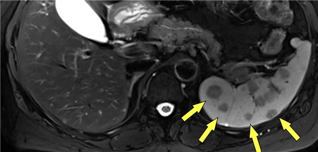 Die MRT (axiales T2-gewichtetes TSE Bild) zeigt multiple Milzläsionen (Pfeile).