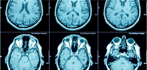 Mehrere Bilder eines MRTs, das einen menschlichen Schädel zeigt. 