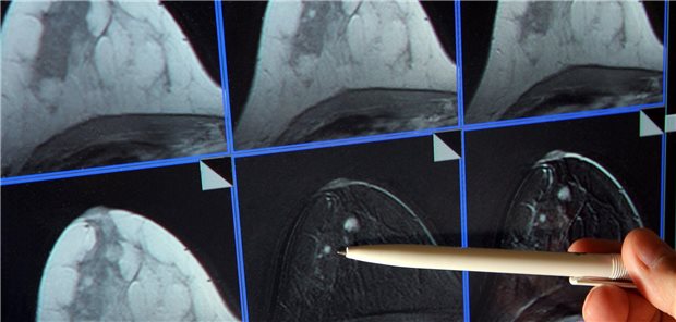 Eine Person zeigt mit einem Kugelschreiber auf Bilder eines Brust-Scans. 