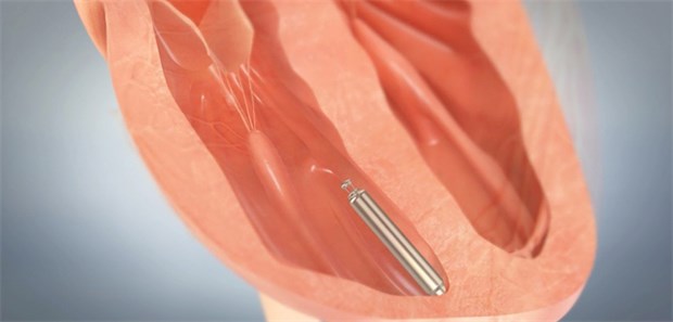 Die Mini-Taktgeber können per Katheter direkt ins Herz vorgeschoben und dort befestigt werden.