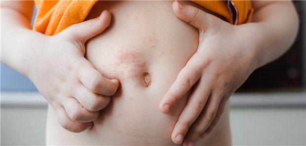 Die Nabelregion gehört zu den Prädilektionsstellen von Skabies. Typisch: kleine, juckende Bläschen am Ende der Milbengänge.