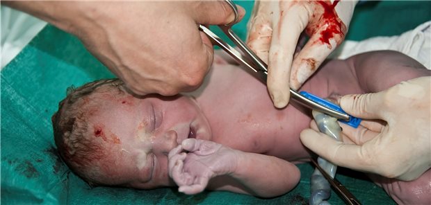 Die Nabelschnur sollte nicht früher als eine Minute nach der Geburt abgeklemmt werden, sofern diese nicht verletzt ist und das Neugeborene keine Hinweise für eine anormale Stresssituation zeigt, empfiehlt die S3-Leitlinie. 