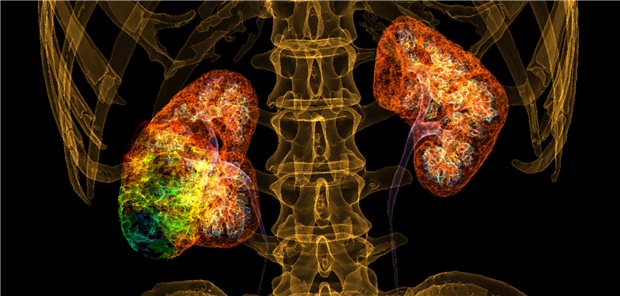 Die Nieren werden bei Menschen mit HIV nicht nur durch das Virus selbst, sondern auch weitere Faktoren, etwa Polypharmazie oder Komorbiditäten.