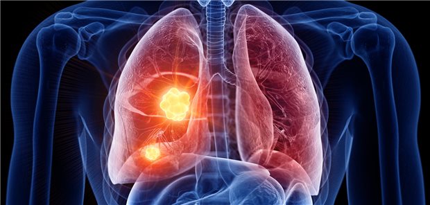 NSCLC: Vorteil für mutationsspezifische Erstlinien-Kombitherapie Die Onkologinnen und Onkologen um Dr. Byoung Cho resümieren, dass sich insgesamt mit Amivantamab plus Lazertinib deutliche Vorteile beim progressionsfreie Überleben und möglicherweise auch beim Gesamtüberleben ergeben. Sie betonen aber, dass diese allerdings mit einer erhöhten Rate schwerer Nebenwirkungen erkauft werden.