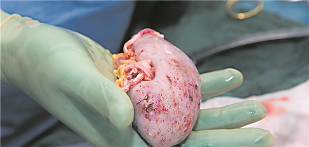 Die Organknappheit zwingt dazu, auch qualitativ grenzwertige Organe zu transplantieren.