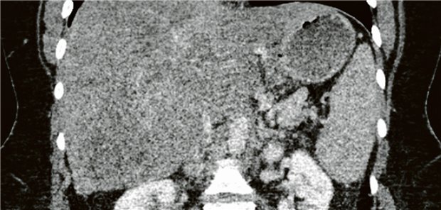 CT des Abdomens, portalvenöse Phase