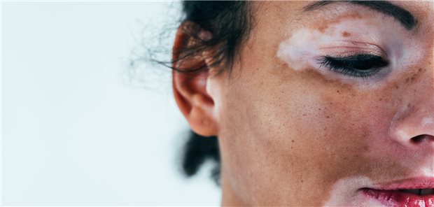 Die Pigmentstörungen bei Vitiligo sind an sich kein gesundheitliches Problem, viele Betroffene leiden aber sehr darunter.