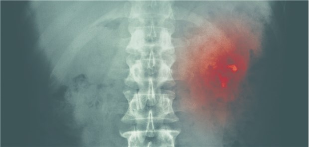 Die Prävalenz von Nierensteinen hängt auch von unterschiedlichen Ernährungsgewohnheiten ab.