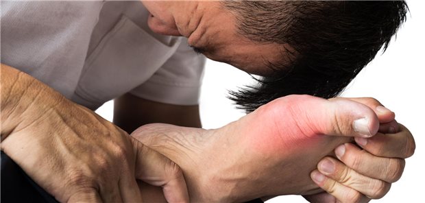 Mann mit schmerzhaftem und geschwollenem rechten Fuß aufgrund einer durch Gicht verursachten Entzündung.