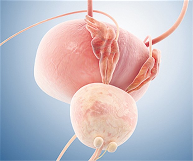 Die umstrittene Rolle des PSA-Screenings Die Prostata - fast alle Männer in höherem Alter haben Tumoren an diesem Organ.