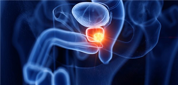 Die Prostatakrebs-Inzidenz ist nach Prostatabiopsie mit nicht malignem Befund deutlich erhöht, doch die krebsspezifische Mortalität ist aktuellen Daten zufolge erniedrigt.
