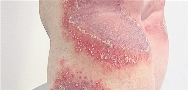 Die Psoriasis pustulosa kommt seltener vor als die „gewöhnliche“ Psoriasis und ist geprägt durch scharf begrenzte Plaques und kleine Pusteln. (Symbolbild für eine Psoriasis pustulosa generalisata)