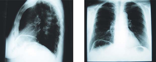 Anatomische Variante mit Folgen für den Darm Die Röntgenbilder zeigen eine Überblähung von Kolonanteilen an der rechten Flexur zwischen Leber und Diaphragma rechts.