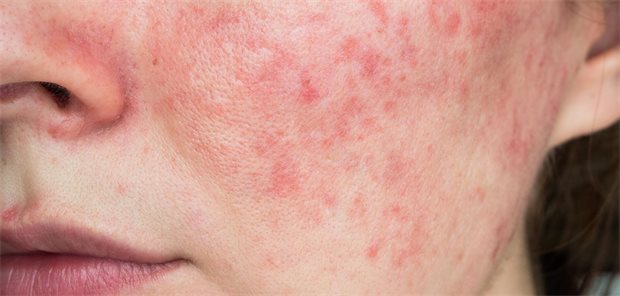 Rosacea-Rötungen auf der Wange einer Patientin.