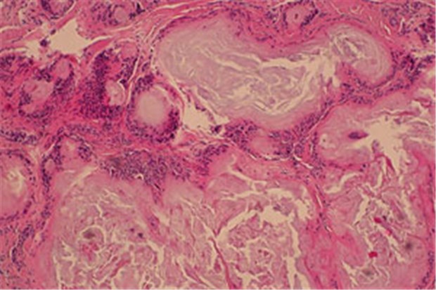 Bei 9 mg/dl muss die Harnsäure immer runter Die Routinehistologie zeigt azelluläres Material umgeben von einem histiozytären Infiltrat mit Fremdkörperriesenzellen.