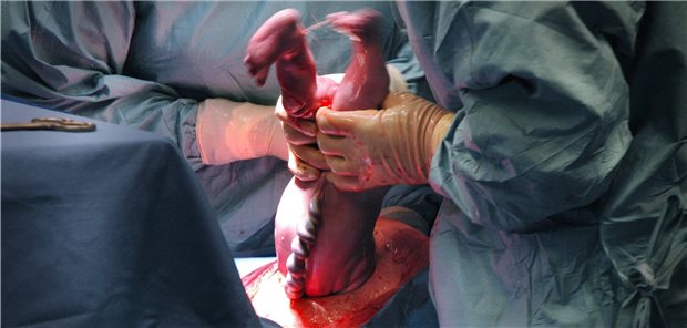 Die Sectiorate liegt laut Zahlen des Statistischen Bundesamtes  von 2018 (letztverfügbarer Stand) in Deutschland bei 29 Prozent.