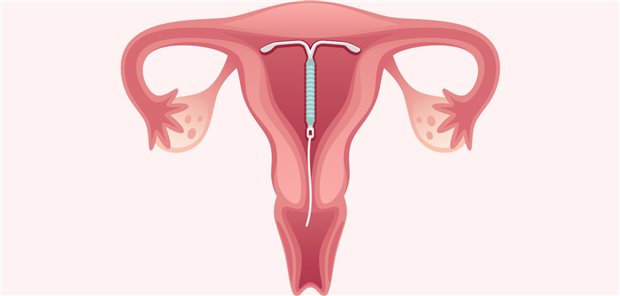 Die Spirale ist in Deutschland nach oralen Kontrazeptiva und dem Kondom die am dritthäufigsten eingesetzte Verhütungsart.