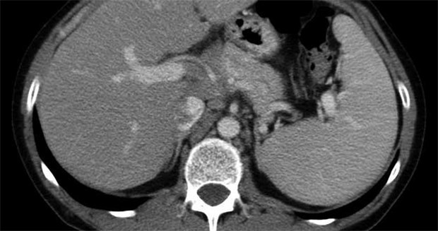 Die Splenomegalie zu reduzieren, ist eines der Therapieziele bei Patienten mit Myelofibrose.