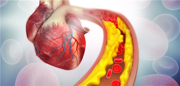 Die Sterblichkeit nach Myokardinfarkt kann bei LDL-C-Senkung um 2 mmol/l (80 mg/dl) über vier Jahre um bis zu 70 Prozent gesenkt werden.