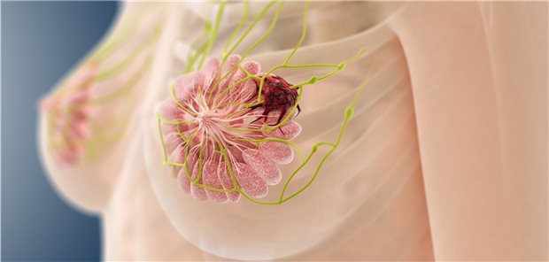 Die Sterblichkeitsrate bei Brustkrebs lag in zertifizierten Zentren der Deutschen Krebsgesellschaft um 11,7 Prozent niedriger als andernorts.