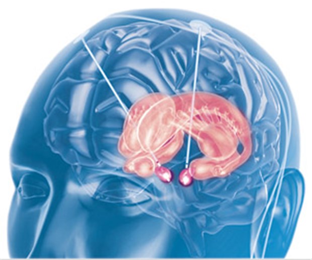 Hirnstimulation bei schweren Dystonien - der Erfolg der Therapie hält langfristig an Die Stimulation des N. subthalamicus (lila) bessert die Motorik, die Stimulation des ventralen Hypothalamus stärkt offenbar das Gedächtnis.