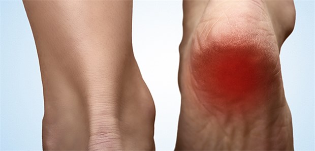 Stoßwellentherapie bei Fersensporn wird Kassenleistung Die Stoßwellentherapie für Fersensporn-Geplagte können Orthopäden, Unfallchirurgen sowie Fachärzte für Physikalische und Rehabilitative Medizin erbringen.