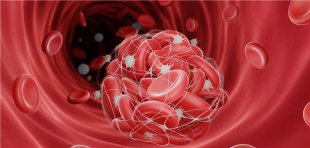 Illustration eines Blutgerinnsels. Thrombose ist eine gefährliche Krankheit, die zu einem Schlaganfall oder Herzinfarkt führen kann.