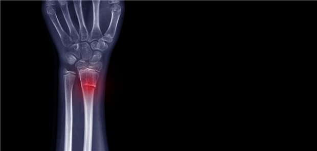 Die Röntgenaufnahme des Handgelenks zeigt einen gebrochenen Handgelenksknochen (Torus- oder Schnallenfraktur) nach einem Sturz. Hervorhebung der Bruchstelle und des schmerzhaften Bereichs.