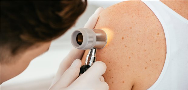 Ein Dermatologe mit Latexhandschuhen, der ein Dermatoskop hält, untersucht einen Patienten auf Melanome.