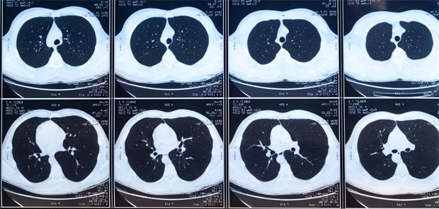 CT Aufnahmen zur Diagnose von möglichen Erkrankungen der Atemwege.