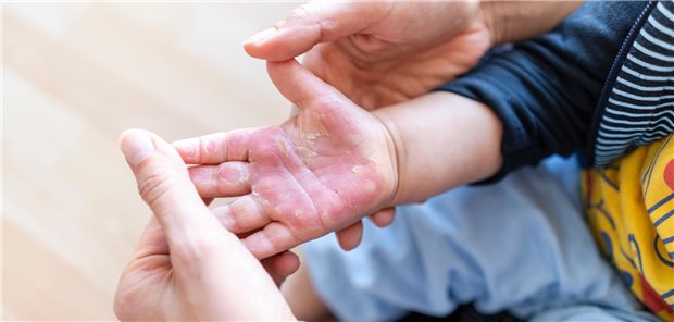 Nahaufnahme der Hand eines kleinen Kindes mit großflächigen, verbrennungsartigen Rötungen.