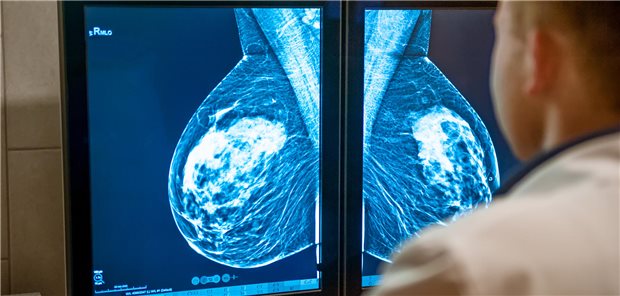 Ein Arzt betrachtet auf zwei Monitoren die Mammographieaufnahme der Brust einer Patientin.