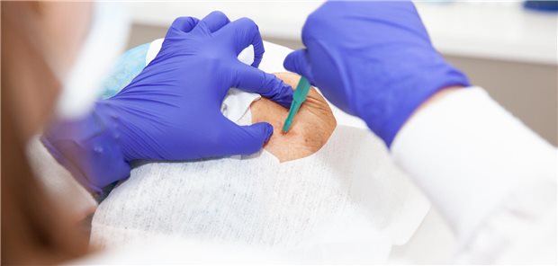 Eine Dermatologin entfernt eine Hautveränderung im Gesicht eines älteren Patienten. 