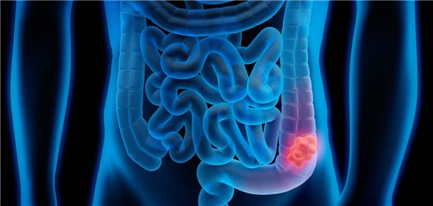 Die Studiengruppe um Georgios Polychronidis resümiert, dass ihre Ergebnisse die Empfehlungen für eine erneute Koloskopie innerhalb von drei bis fünf Jahren bei Personen mit Hochrisiko- und ein längeres Intervall bei Personen mit Niedrigrisiko-Adenomen/serratierten Polypen unterstützen. 