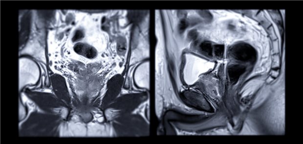Die Studiengruppe um den Urologen Fredrik Möller resümiert, dass eine nicht zu vernachlässigende Zahl von Männern mit PSA-Werten von 1,8 bis 3,0 ng/ml ein klinisch signifikantes Prostatakarzinom haben. Für diese scheine das MRT als Selektionswerkzeug für die Biopsie zu funktionieren, ohne die Überdiagnostik von Prostatakrebs zu erhöhen.