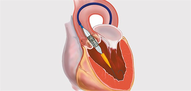 Die TAVI-Methode, bei der die neue Aortenklappe per Herzkatheter in die richtige Position gebracht wird, kann Patienten eine Operation mit Brusteröffnung ersparen.