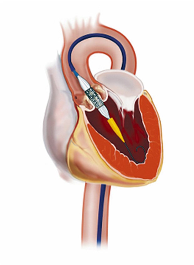 Aortenstenose: Klappenersatz per Herzkatheter so gut wie Operation Die TAVI-Methode, bei der die neue Aortenklappe per Herzkatheter in die richtige Position gebracht wird, kann Patienten eine Operation mit Brusteröffnung ersparen.