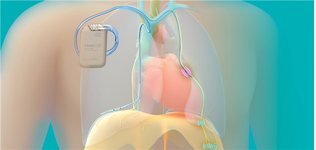 Mit Schrittmacher gegen Schlafapnoe Die Technik der Schrittmacher-Stimulation im Detail: Die Stimulationselektrode liegt in der epikardiophrenischen Vene in Nähe des N. phrenicus. respicardia.com