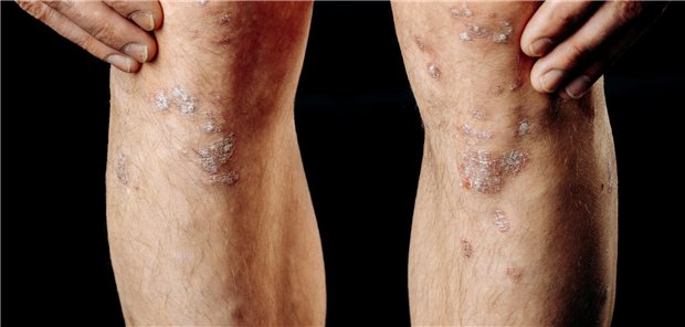 Zwei Knie mit Psorasis-Ausschlägen.